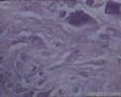 左大腿肿块：恶性组？非典型性纤维组织细胞瘤？图18