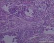 头皮肿物：皮脂腺癌？转移性透明细胞癌？图11