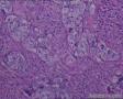 头皮肿物：皮脂腺癌？转移性透明细胞癌？图19