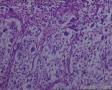 头皮肿物：皮脂腺癌？转移性透明细胞癌？图10