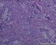 头皮肿物：皮脂腺癌？转移性透明细胞癌？图20