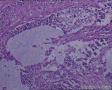 头皮肿物：皮脂腺癌？转移性透明细胞癌？图18
