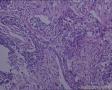头皮肿物：皮脂腺癌？转移性透明细胞癌？图14