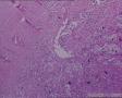 头皮肿物：皮脂腺癌？转移性透明细胞癌？图8
