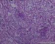 头皮肿物：皮脂腺癌？转移性透明细胞癌？图12