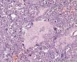 这个病例诊断什么？巨细胞修复性肉芽肿？骨巨细胞瘤？图19