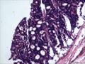前列腺癌，Gleason4+4?图8