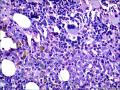 结节性淋巴细胞为主型霍奇金淋巴瘤？图12