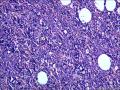 结节性淋巴细胞为主型霍奇金淋巴瘤？图26