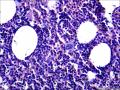 结节性淋巴细胞为主型霍奇金淋巴瘤？图1