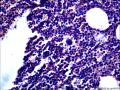 结节性淋巴细胞为主型霍奇金淋巴瘤？图14