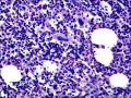 结节性淋巴细胞为主型霍奇金淋巴瘤？图5
