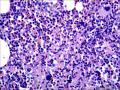 结节性淋巴细胞为主型霍奇金淋巴瘤？图13