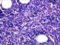 结节性淋巴细胞为主型霍奇金淋巴瘤？图4