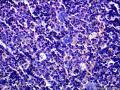 结节性淋巴细胞为主型霍奇金淋巴瘤？图8