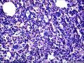 结节性淋巴细胞为主型霍奇金淋巴瘤？图10