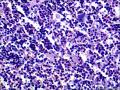 结节性淋巴细胞为主型霍奇金淋巴瘤？图6