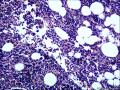 结节性淋巴细胞为主型霍奇金淋巴瘤？图22