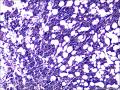 结节性淋巴细胞为主型霍奇金淋巴瘤？图16