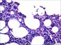 结节性淋巴细胞为主型霍奇金淋巴瘤？图3