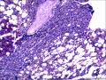 结节性淋巴细胞为主型霍奇金淋巴瘤？图17