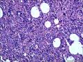 结节性淋巴细胞为主型霍奇金淋巴瘤？图25