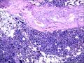 结节性淋巴细胞为主型霍奇金淋巴瘤？图19
