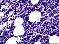 结节性淋巴细胞为主型霍奇金淋巴瘤？图15