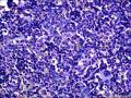 结节性淋巴细胞为主型霍奇金淋巴瘤？图9