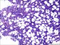 结节性淋巴细胞为主型霍奇金淋巴瘤？图18