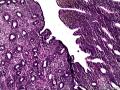 子宫肌瘤 子宫内膜见小团腺样结构图5