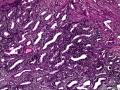 子宫肌瘤 子宫内膜见小团腺样结构图4