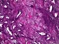 子宫肌瘤 子宫内膜见小团腺样结构图7