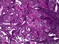 子宫肌瘤 子宫内膜见小团腺样结构图12