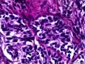 子宫肌瘤 子宫内膜见小团腺样结构图9