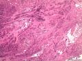 子宫肌瘤 子宫内膜见小团腺样结构图1