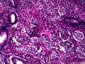 子宫肌瘤 子宫内膜见小团腺样结构图13