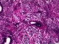 子宫肌瘤 子宫内膜见小团腺样结构图11