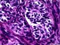 子宫肌瘤 子宫内膜见小团腺样结构图10