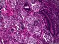 子宫肌瘤 子宫内膜见小团腺样结构图8