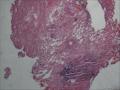 膀胱粘膜，腺性膀胱炎伴鳞化图8