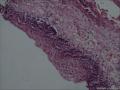 膀胱粘膜，腺性膀胱炎伴鳞化图2