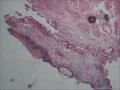 膀胱粘膜，腺性膀胱炎伴鳞化图1
