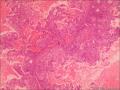 子宫内膜样腺癌图5