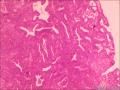 子宫内膜样腺癌图4