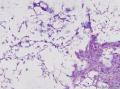 这些是什么菌团，上皮细胞纤毛存在，有异型？图12