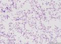 这些是什么菌团，上皮细胞纤毛存在，有异型？图11