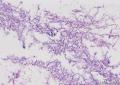 这些是什么菌团，上皮细胞纤毛存在，有异型？图5