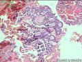子宫内膜腺癌图3