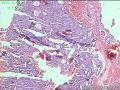 子宫内膜腺癌图2